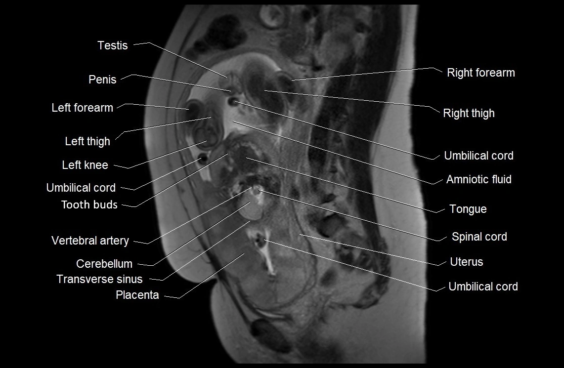 MRI fetal anatomy sagittal image 16.webp